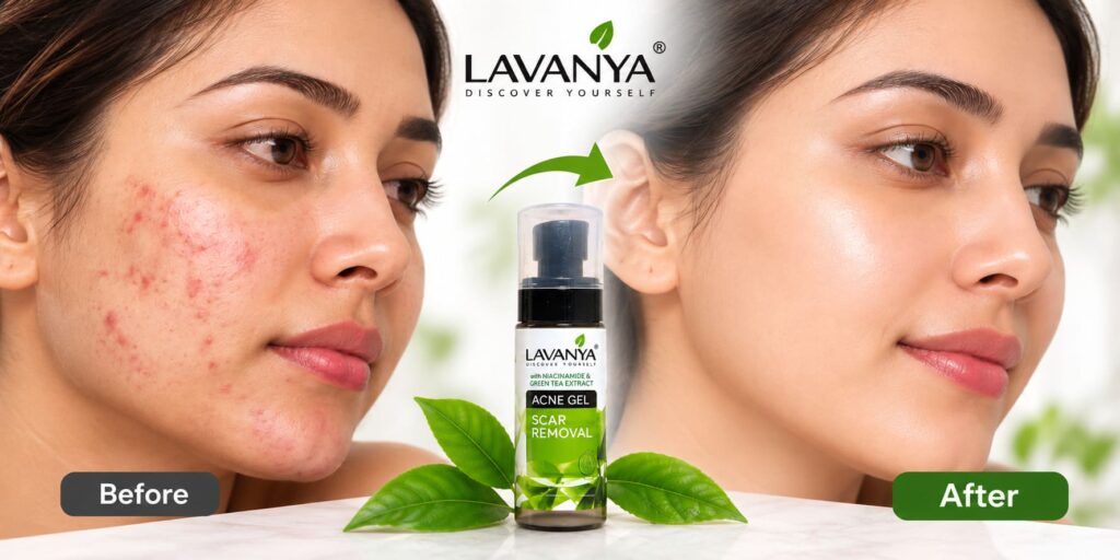before and after results of lavanya acne gel and scar removal